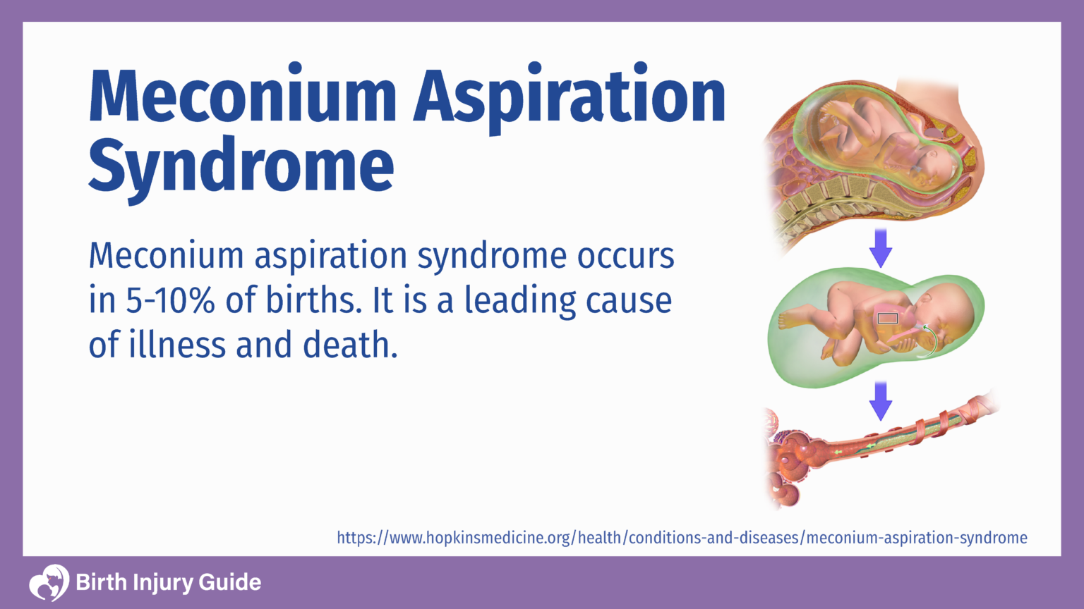 Meconium Aspiration Syndrome Mas Birth Injury Guide