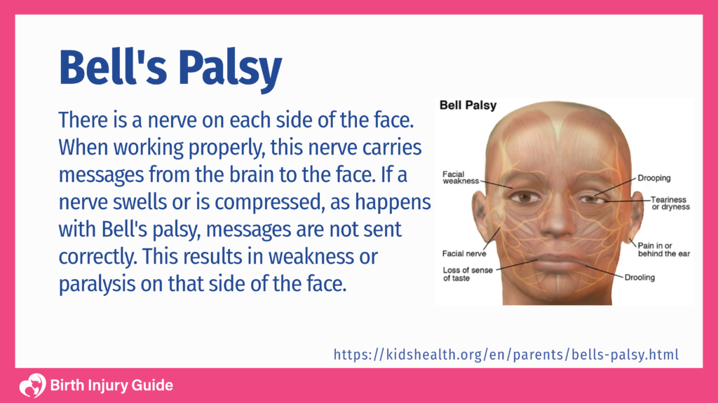 Infant Bell’s Palsy | Facial Paralysis