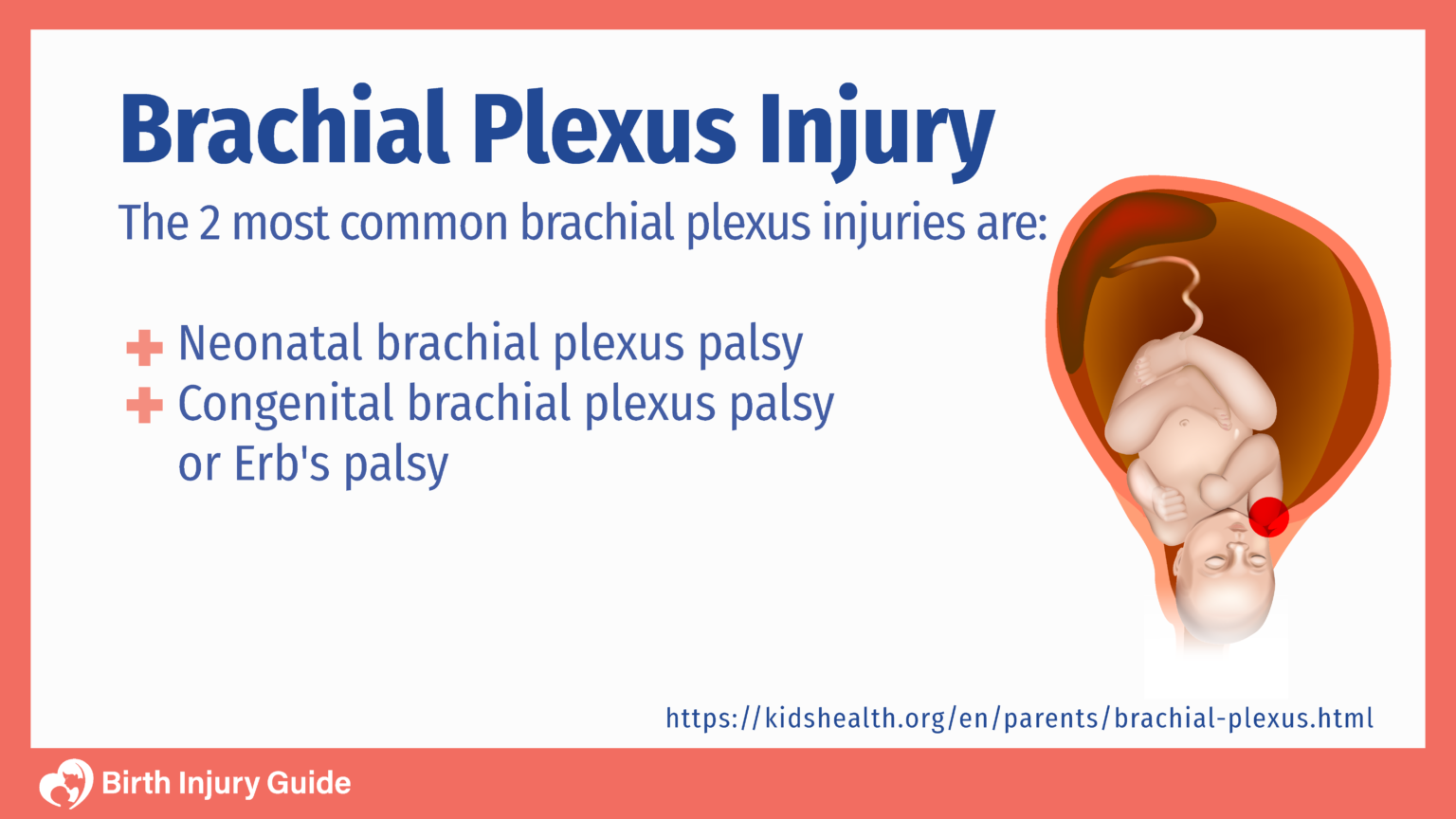 Brachial Plexus Injury - Birth Injury Guide