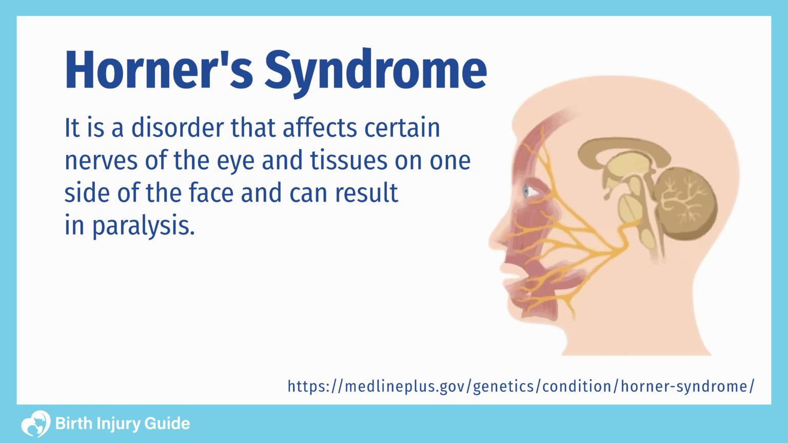 Horner's Syndrome, Causes, Symptoms and Treatment