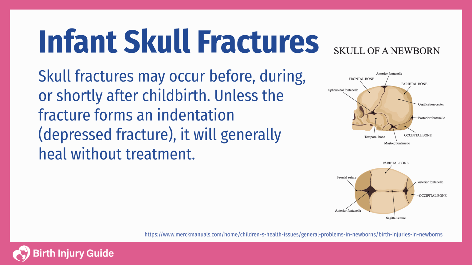 Infant Skull Fractures | Birth Injury Guide