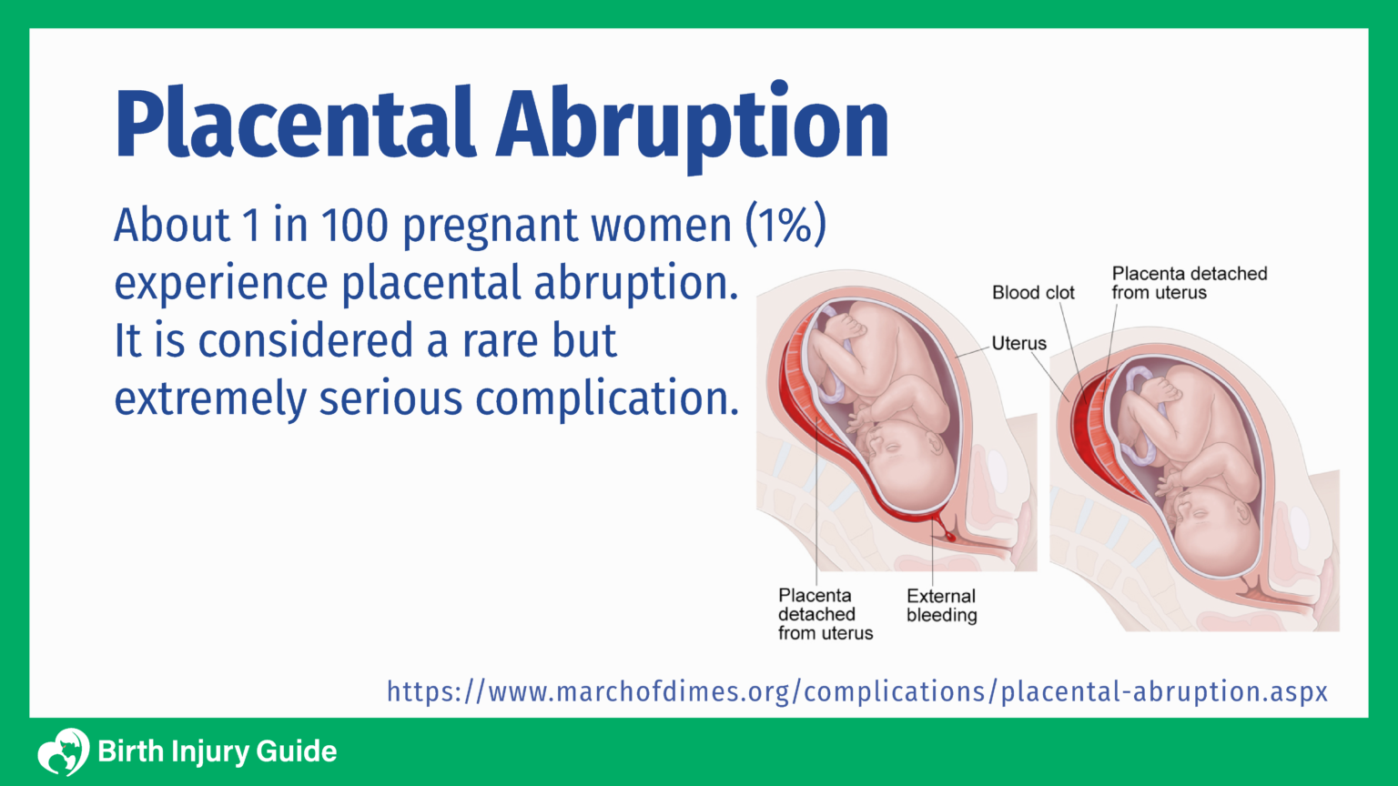 Placental Abruption Birth Injury Guide