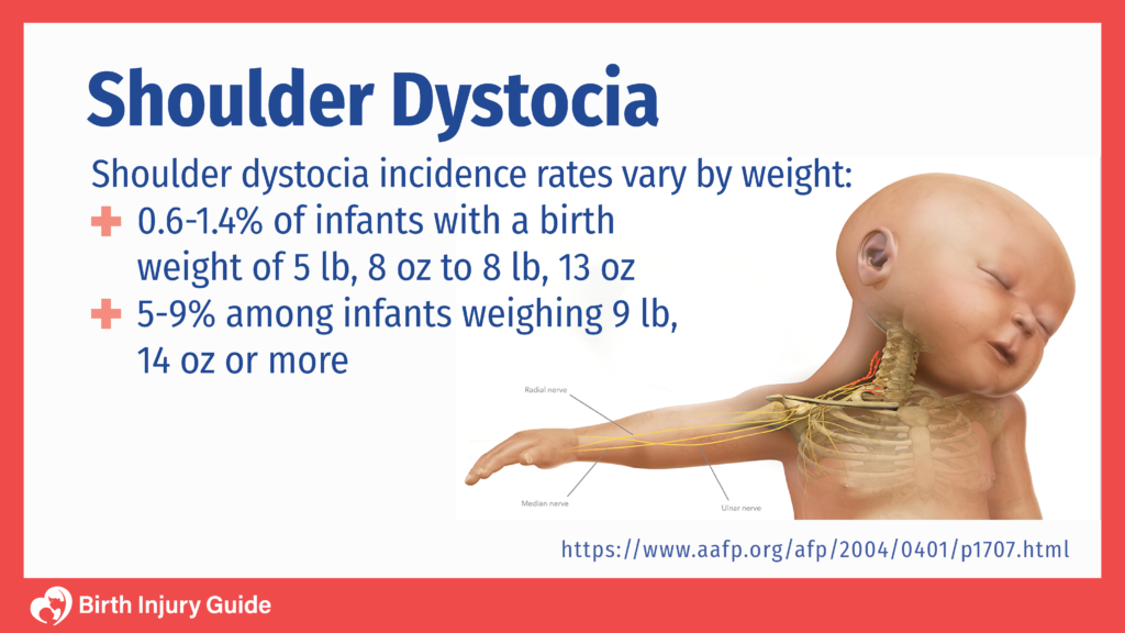 Infant Shoulder Dystocia | Birth Injury Guide