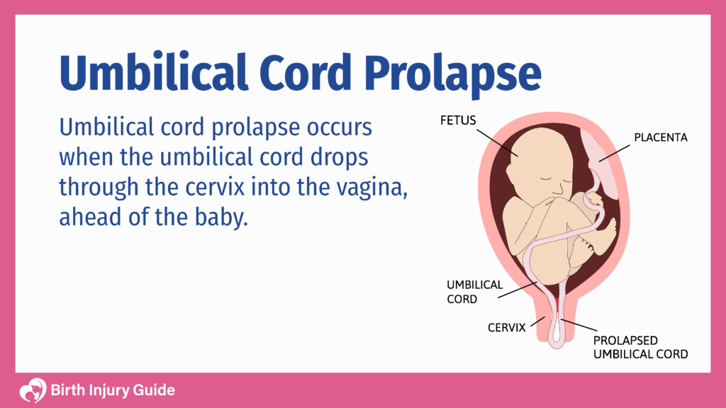 Umbilical Cord Prolapse Birth Injury Guide   Umbilical Cord Prolapse 1024x576 